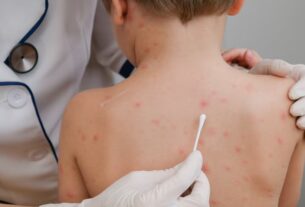 Brote de sarampión: quiénes deben vacunarse y dónde se aplican las dosis