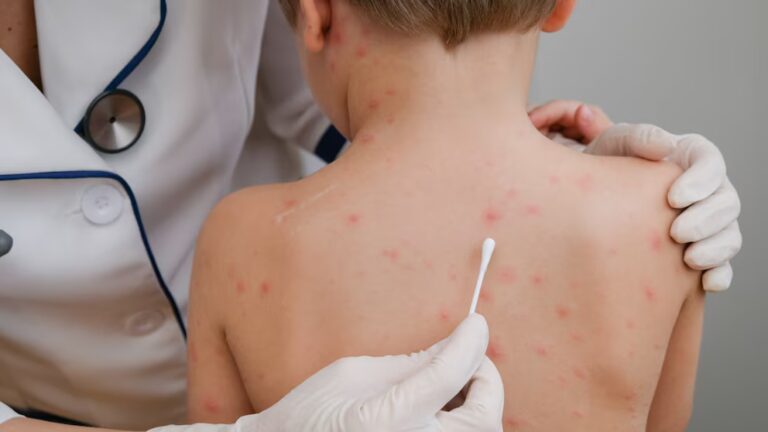 Brote de sarampión: quiénes deben vacunarse y dónde se aplican las dosis